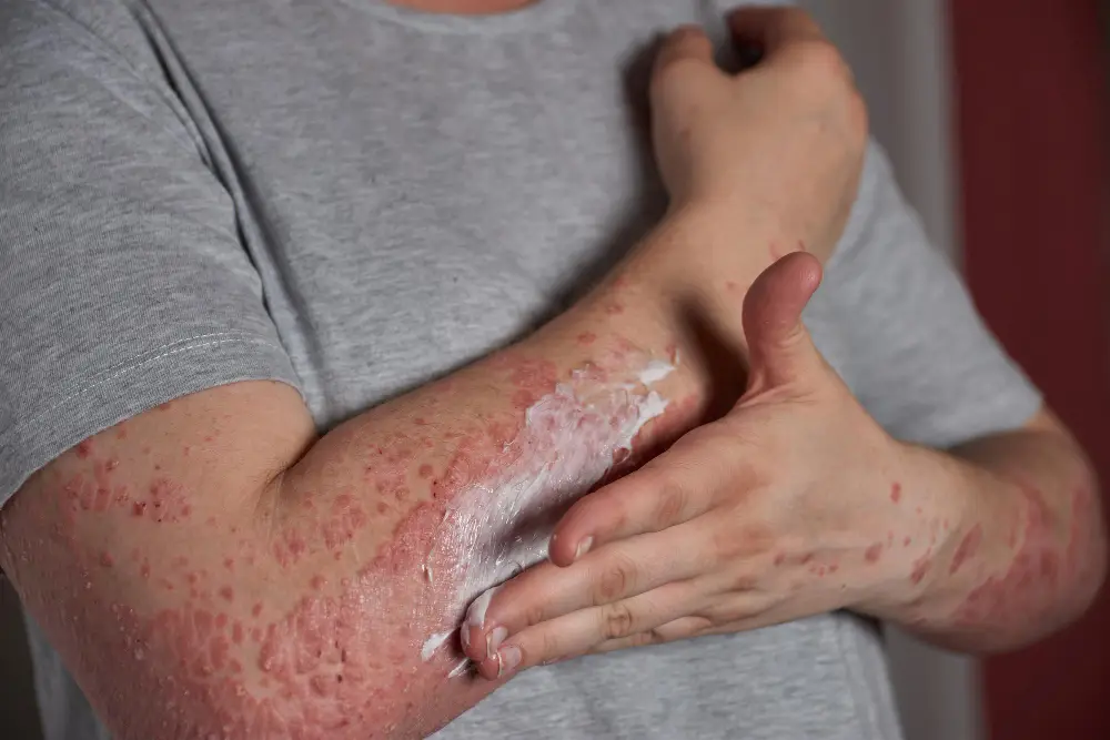 Eczema