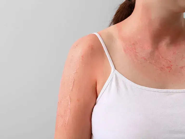 Skin Allergies